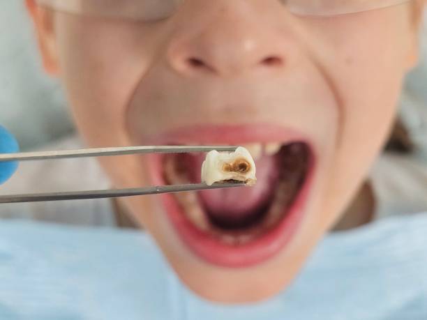 Best Knocked-Out Tooth (Avulsed Tooth) Treatment in Leland, NC